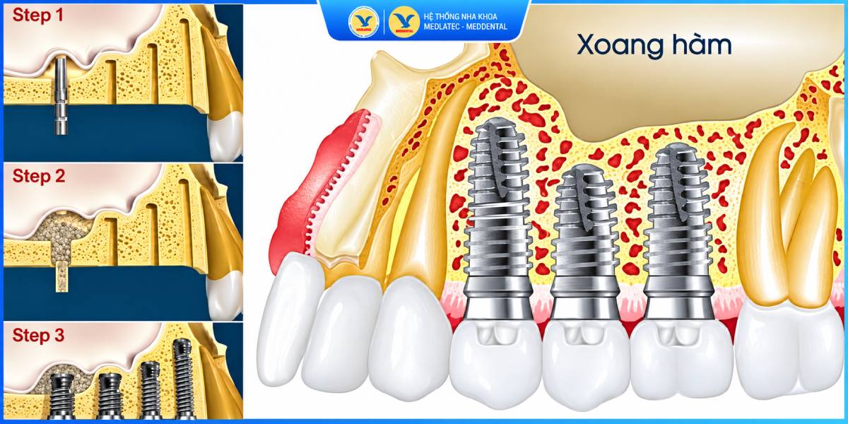 Nâng xoang kín tiếp cận sàn xoang qua vị trí chuẩn bị đặt Implant ở mào xương